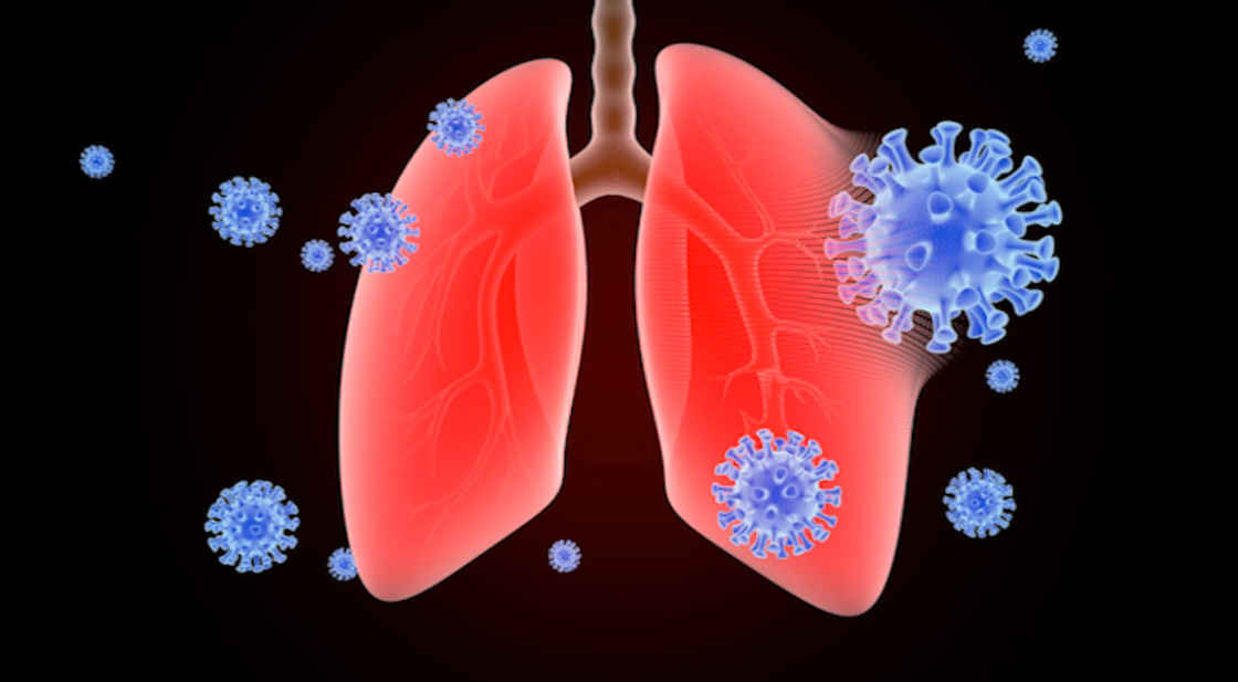 Aumentan casos de neumonía y bronconeumonía en invierno: IMSS Tlaxcala