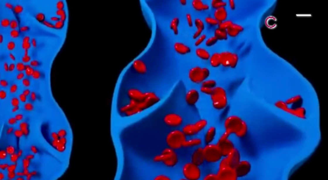 La trombosis puede ser mortal si no se detecta a tiempo: Issste Tlaxcala