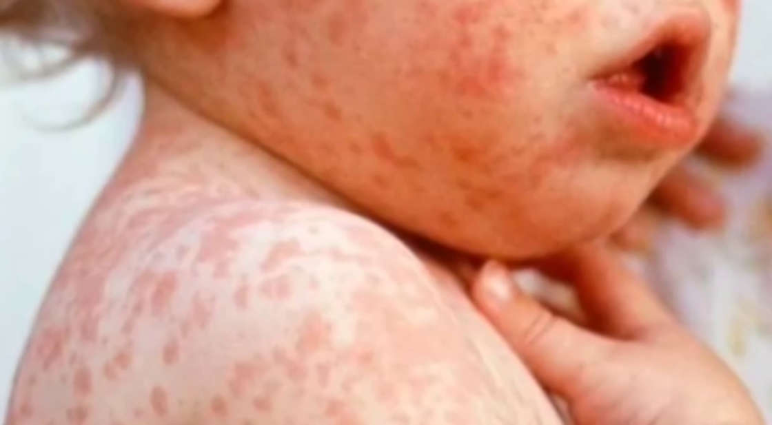 Tlaxcala sin sarampión gracias a campaña de vacunación