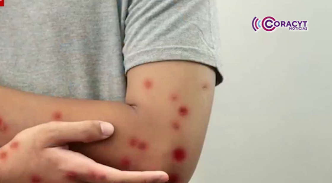 Refuerzan vacunación contra el sarampión en Tlaxcala