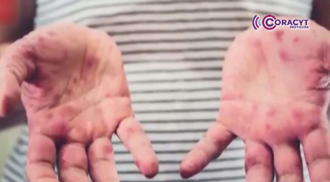 Registra Sector Salud 15 casos del virus Coxsackie en Tlaxcala